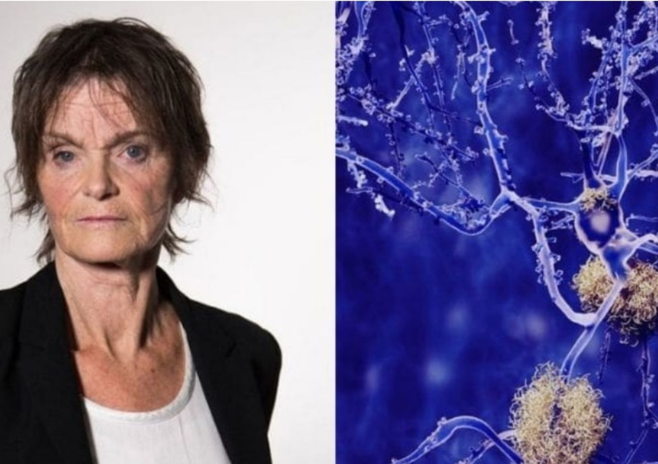 Cientista está a um passo da cura da esclerose múltipla