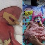 Menor bebê prematuro do mundo recebe alta após 13 meses na UTI