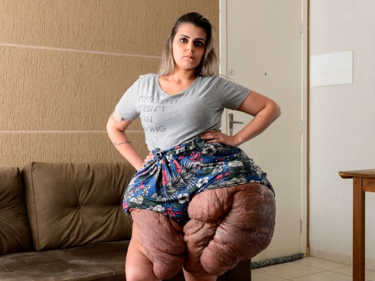 Mulher tem 30 kg de tumores removidos do corpo após operação inédita no Brasil