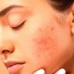 Quais os tipos de manchas no rosto e como tirá-las?