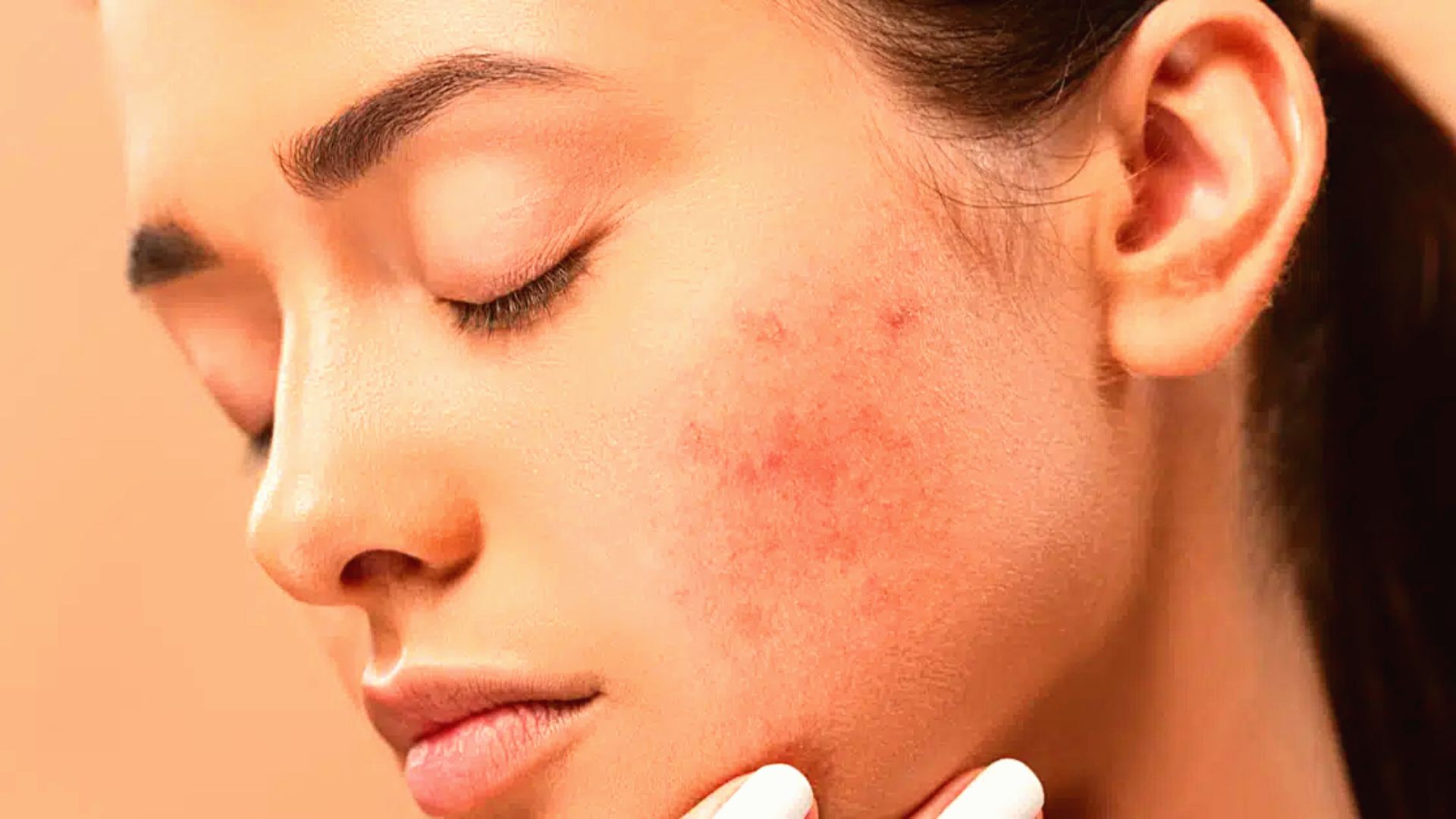Quais os tipos de manchas no rosto e como tirá-las?
