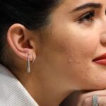 O que os lugares onde você tem espinhas revelam sobre sua saúde