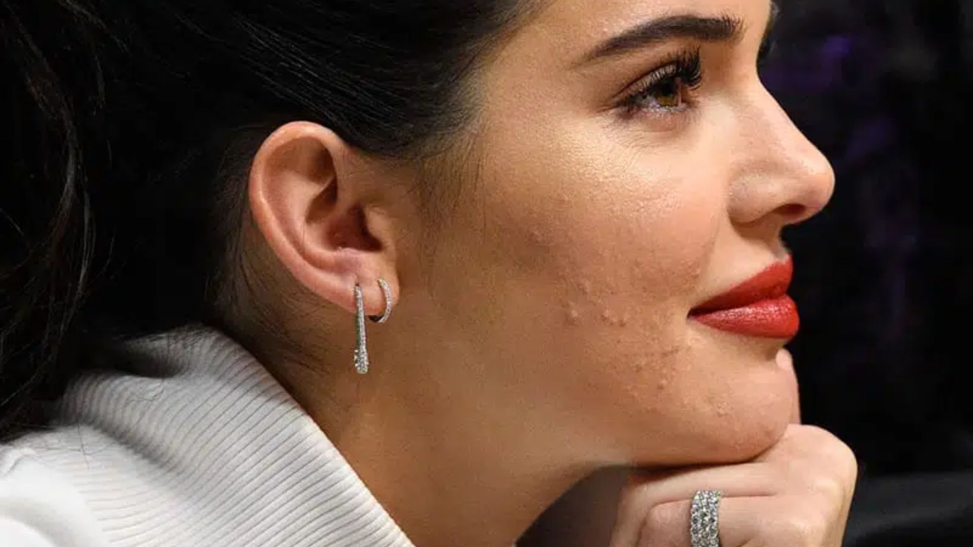 O que os lugares onde você tem espinhas revelam sobre sua saúde