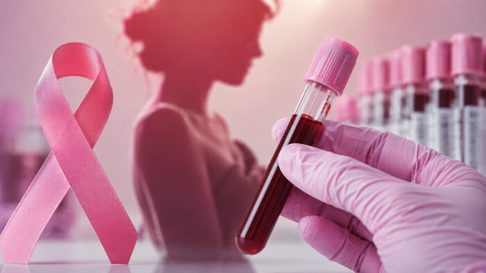 Teste de sangue brasileiro pode ajudar a detectar câncer de mama ainda no início