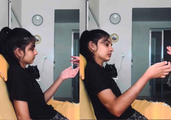 Jovem tetraplégica volta a mover os braços após tratamento inovador