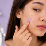 Acne Patches: eles realmente ajudam a tratar as espinhas?