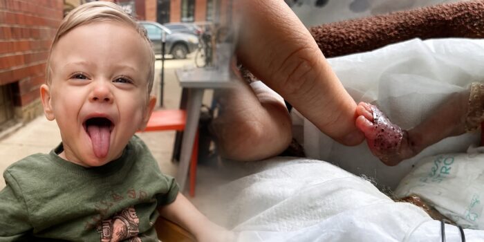 Bebê prematuro que nasceu com 21 semanas completa dois anos e está cada vez mais forte